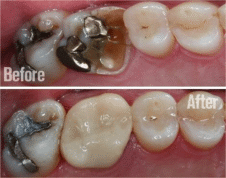 Dental Crowns