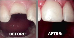 Dental Crowns before and after